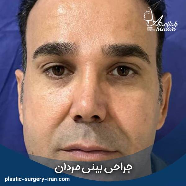 عمل بینی مردانه