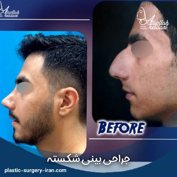 جراحی بینی شکسته