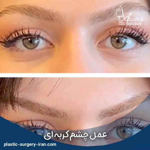 لیفت چشم گربه ای 