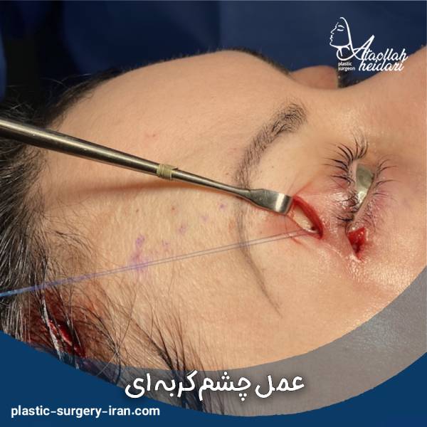 لیفت چشم گربه ای