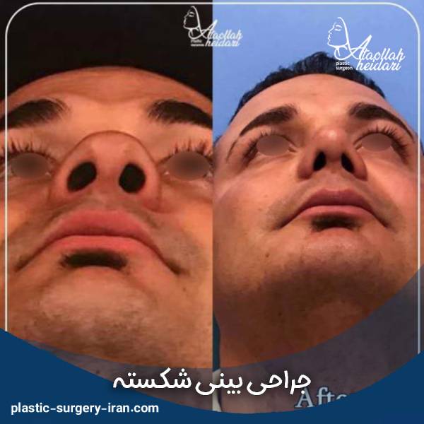 عمل بینی شکسته