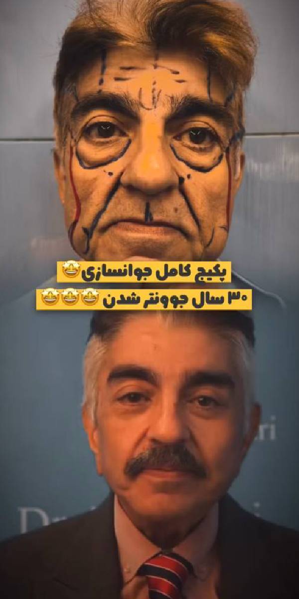 عکس عمل لیفت صورت