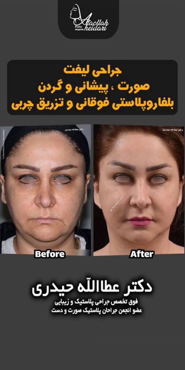 عکس نمونه عمل لیفت صورت