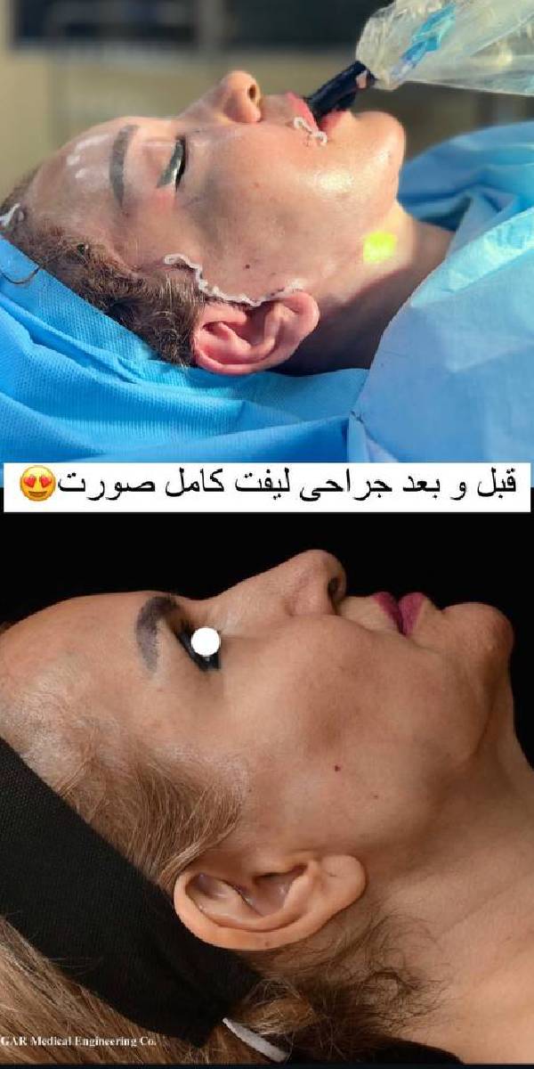 عکس نمونه جراحی لیفت صورت