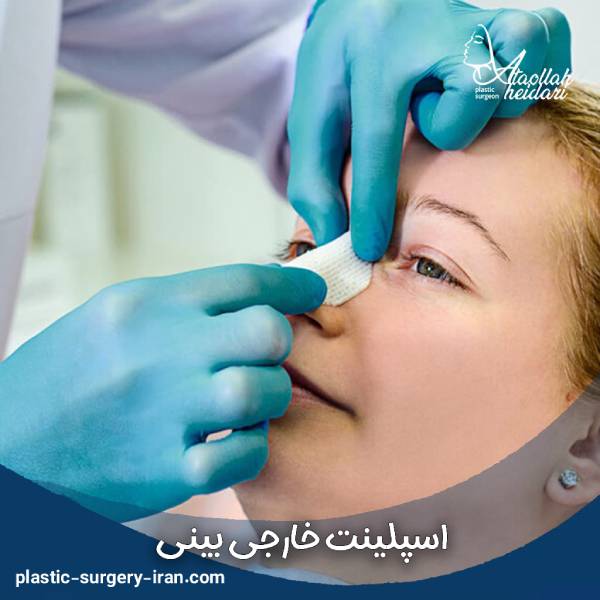 اسپلینت خارجی