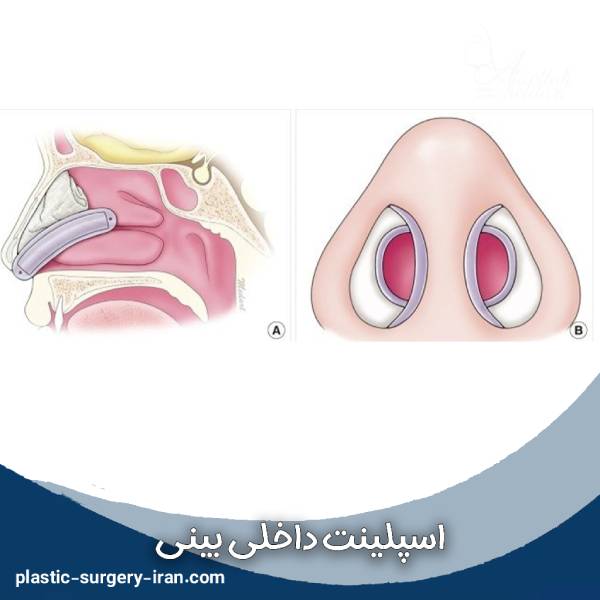 اسپلینت بینی