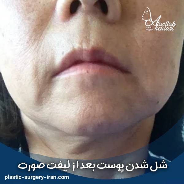 شل شدن پوست بعد از لیفت صورت