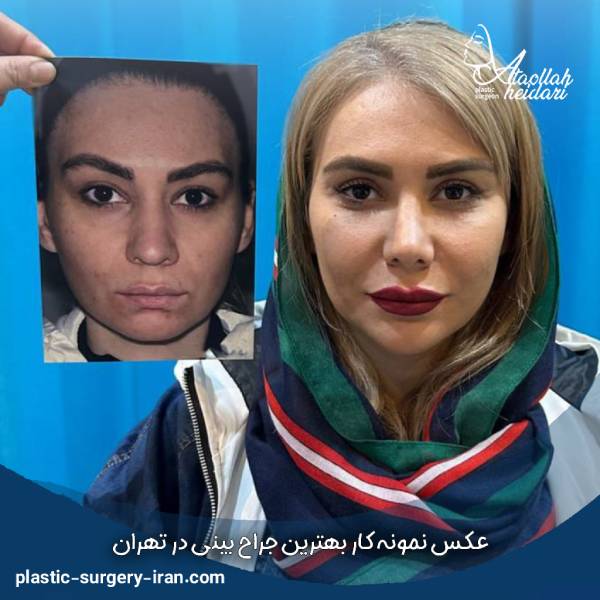 عکس نمونه عمل بینی توسط بهترین جراح بینی تهران 