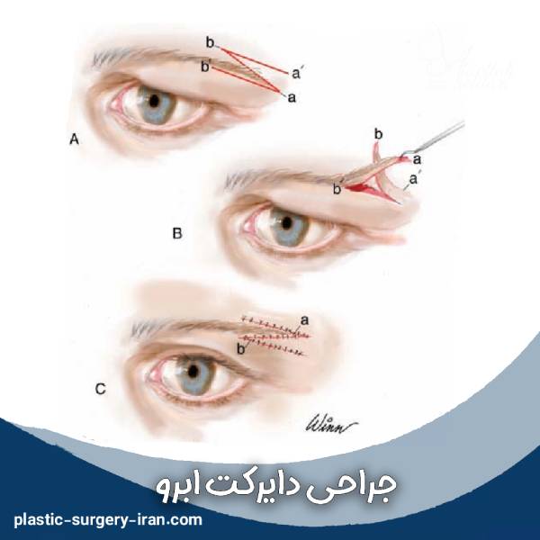جراحی دایرکت ابرو