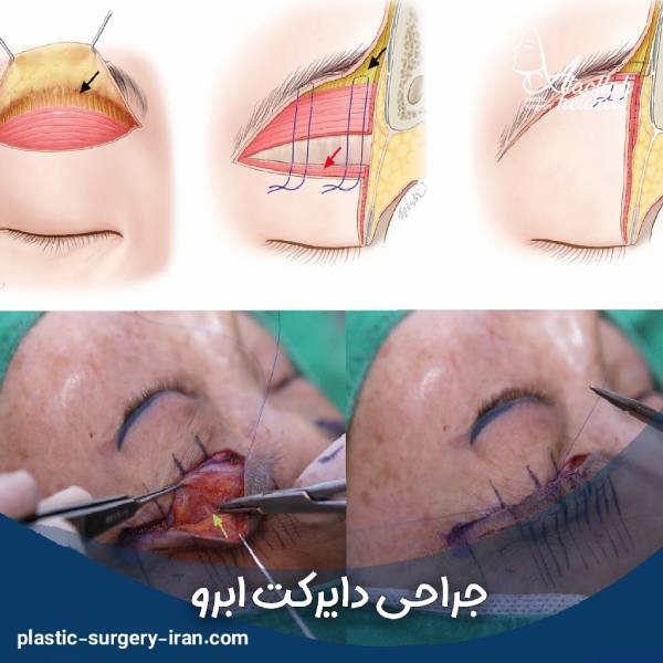 عکس جراحی دایرکت ابرو