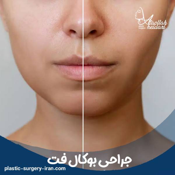 جراحی بوکال فت
