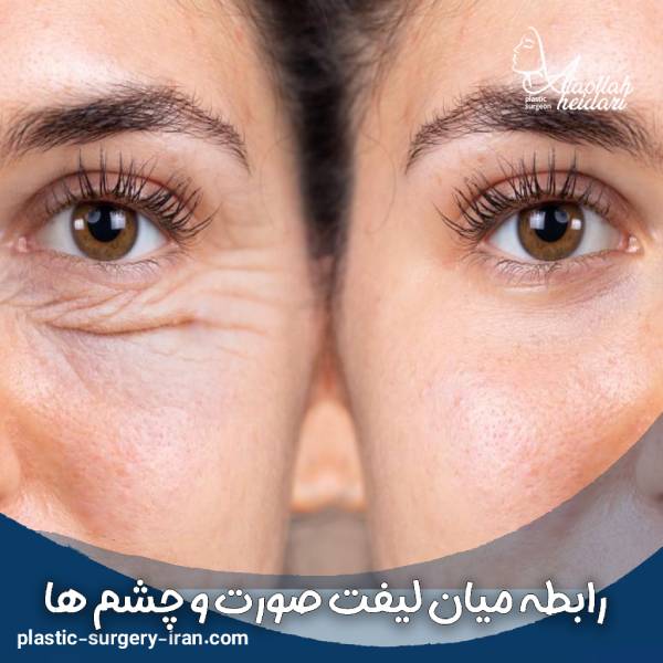تاثیر لیفت صورت بر چشم