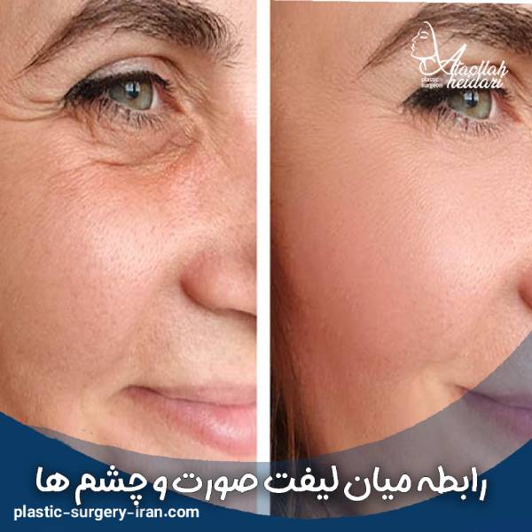 رابطه بین لیفت صورت و چشم