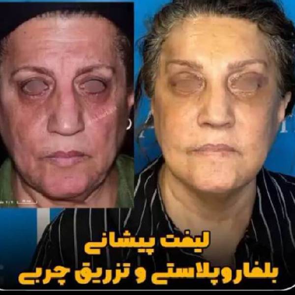 لیفت صورت و تزریق چربی