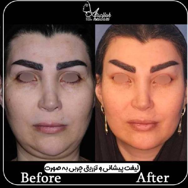 لیفت صورت و تزریق چربی