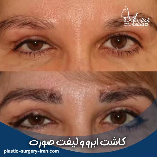 کاشت ابرو و لیفت صورت