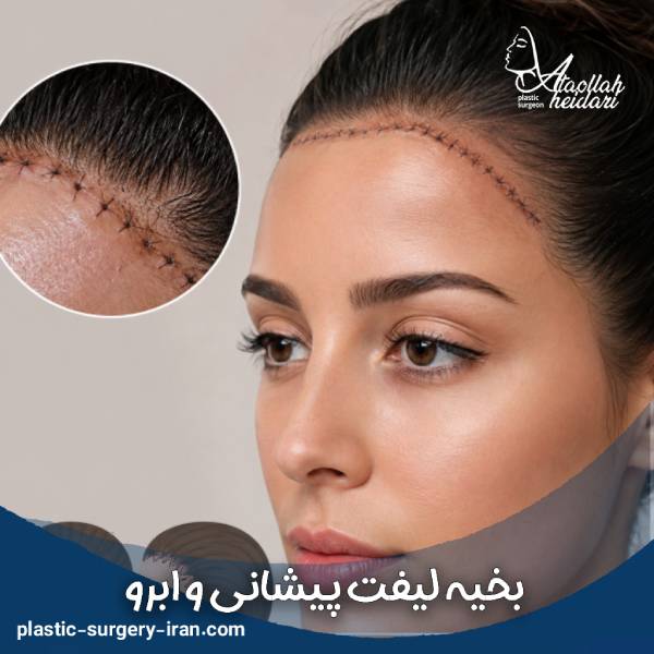 بخیه لیفت پیشانی