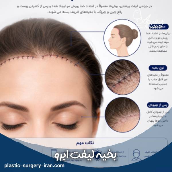 بخیه لیفت پیشانی