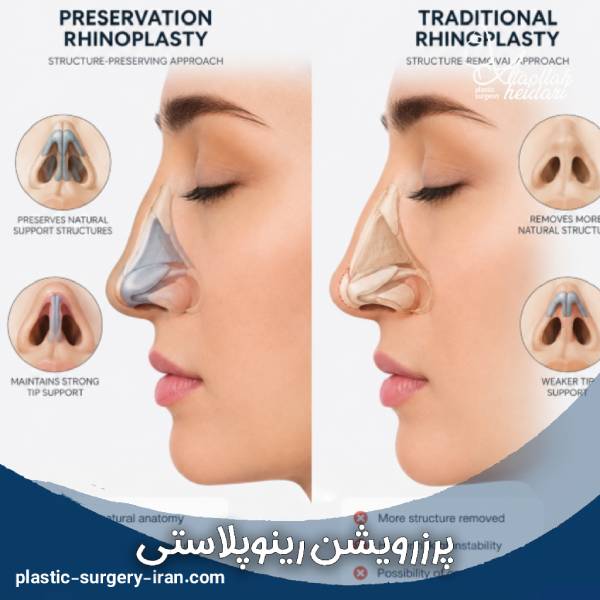 پرزرویشن رینوپلاستی