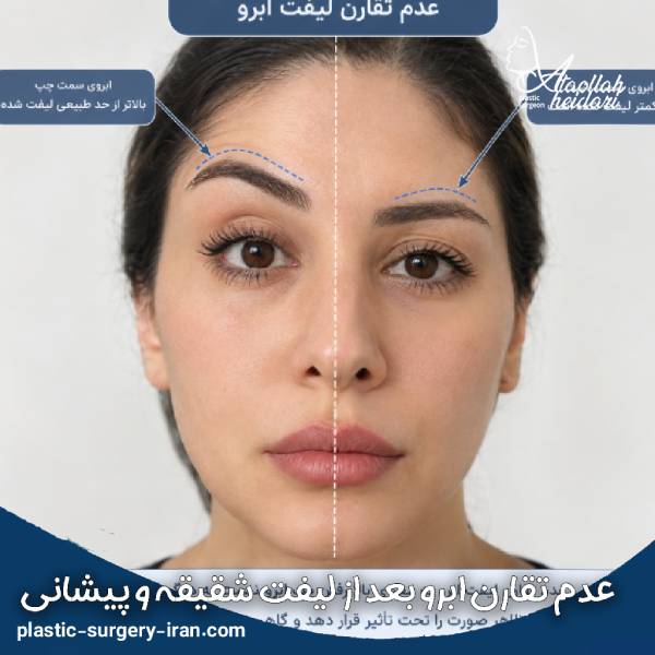 عدم تقارن بعد از لیفت ابرو